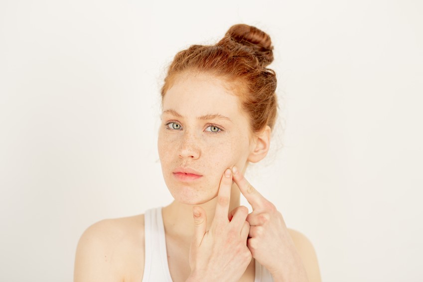 Treatment of Acne (Acne Vulgaris)