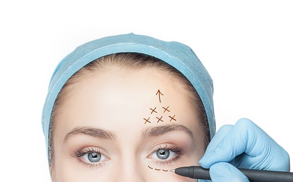 Thread Lifting of the Eyebrows and Forehead