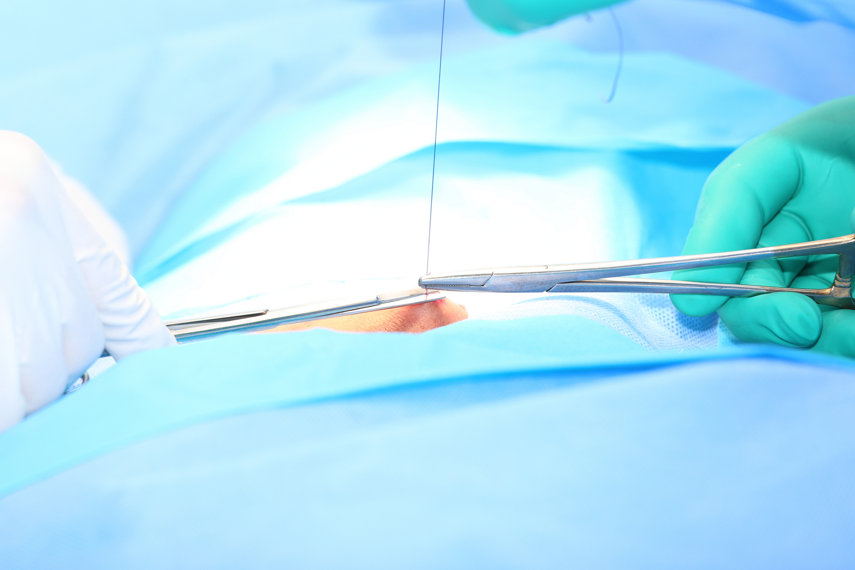 Снятие швов после операции