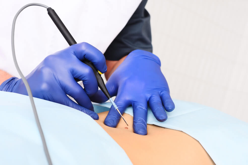 Электрокоагуляция кондилом