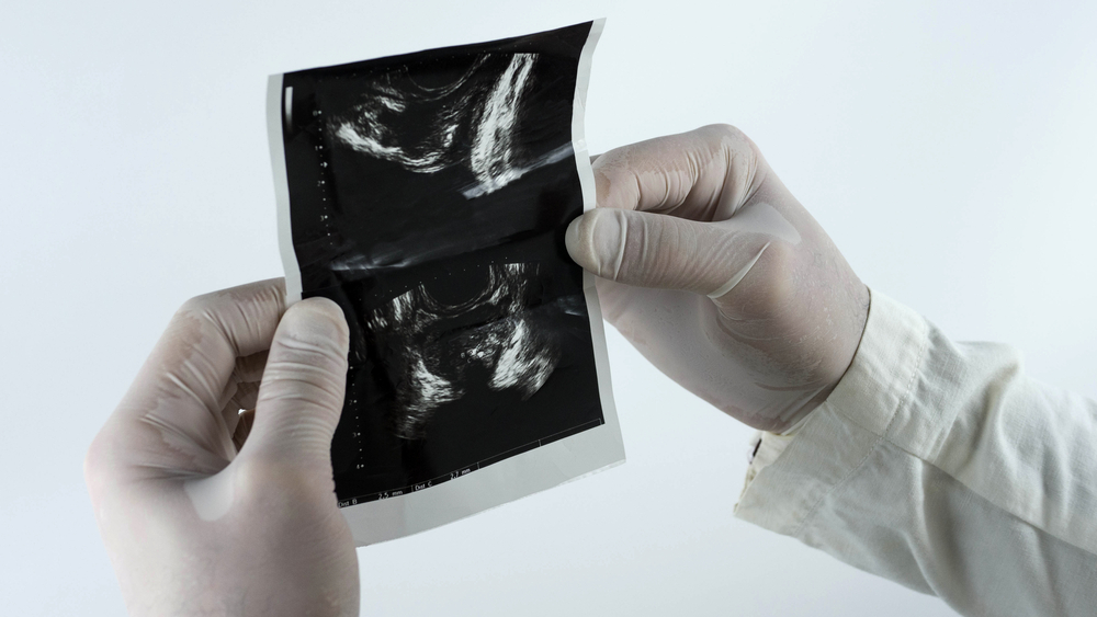 УЗ-диагностика предстательной железы УЗИ предстательной железы